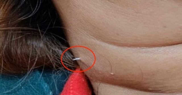 Xương cá mắc trong cổ họng, 2 tuần sau đâm xuyên qua cổ người phụ nữ