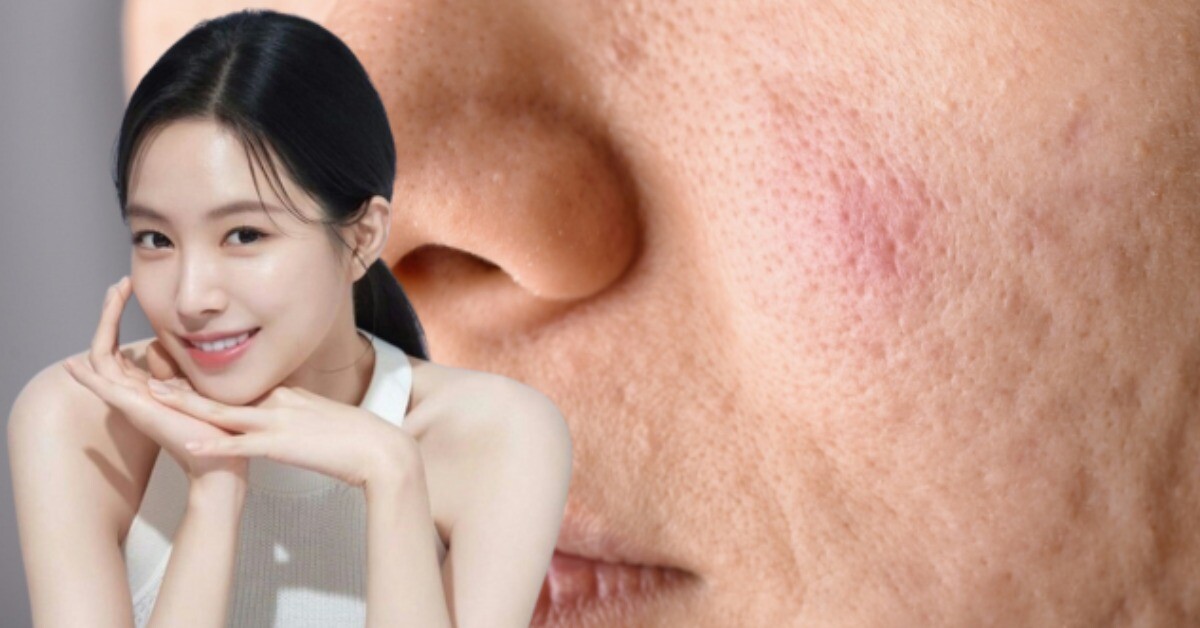 5 bước làm đẹp từ trong ra ngoài giúp xóa mờ lỗ chân lông to, tạm biệt khuôn mặt bóng loáng dầu