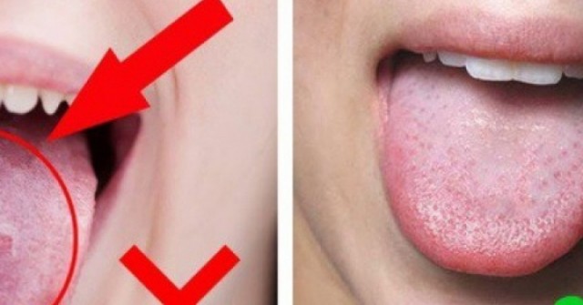 Những dấu hiệu ở lưỡi cảnh báo vấn đề sức khỏe đáng lo ngại mà nhiều người bỏ qua