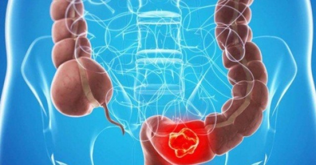 8 dấu hiệu cảnh báo sớm ung thư đại trực tràng