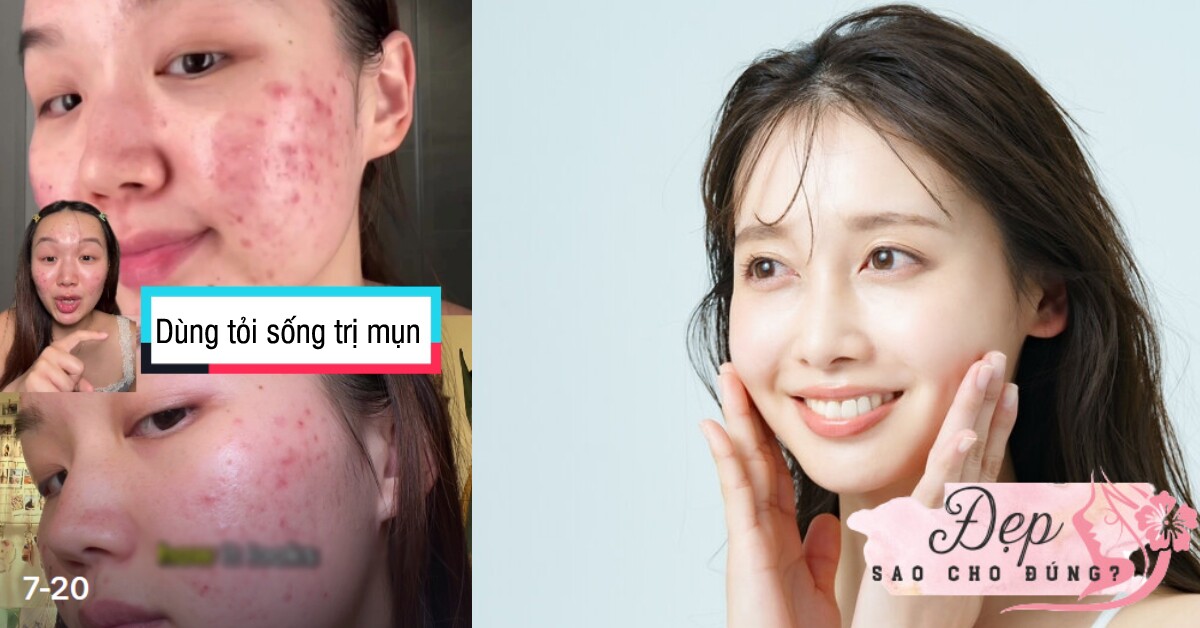 Phương pháp trị mụn bằng tỏi "hot" trên TikTok có thực sự hiệu quả hay hại da? Bác sĩ da liễu chỉ cách làm đúng nhất