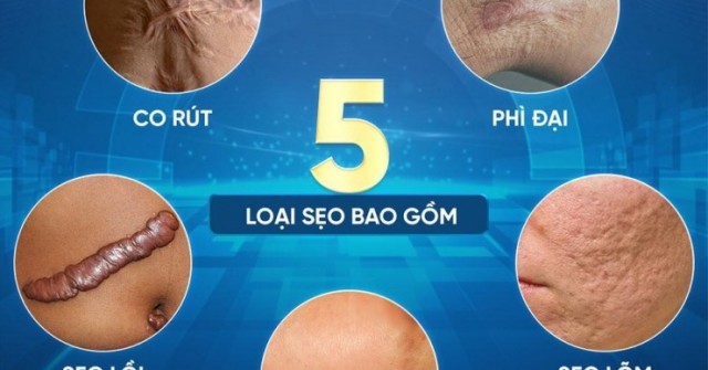 Sửa sẹo căng mô bề mặt: Giải pháp y khoa hiện đại cho làn da sẹo lồi, rỗ, sần sùi tại phòng khám PD de Paris